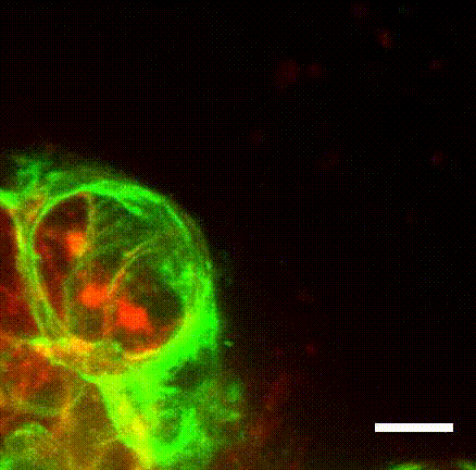 Animated gif of cancer cell restrained by myoepithelium