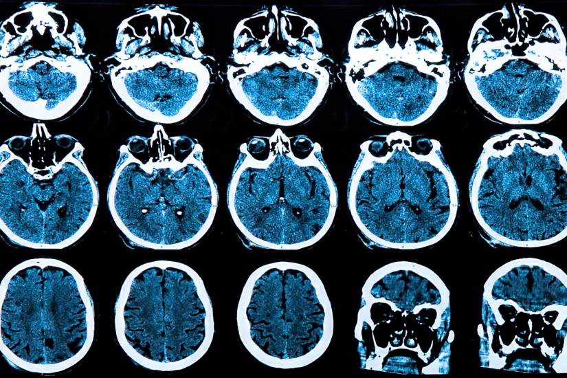 Drug combination preserves cognitive function in mice with Alzheimer's ...