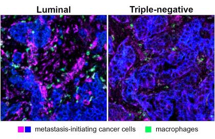 An image of cells that are colored by type: purple and blue cells are metastasis-initiating cancer cells, while green cells are macrophages. The blue and purple are much more prevalent than the green. 