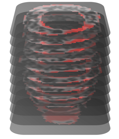 A contrast-enhanced cardiac MRI of a patient with hypertrophic cardiomyopathy deemed by MAARS to be at high risk for sudden death. Each image slice through the heart goes from dark (normal heart tissue) to bright (fibrotic, abnormal tissue). AI marks in red areas with the most fibrosis. 