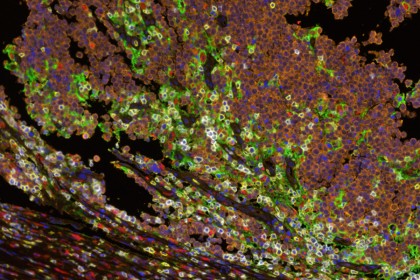 Microscopic look at Merkel cancer tumor cells