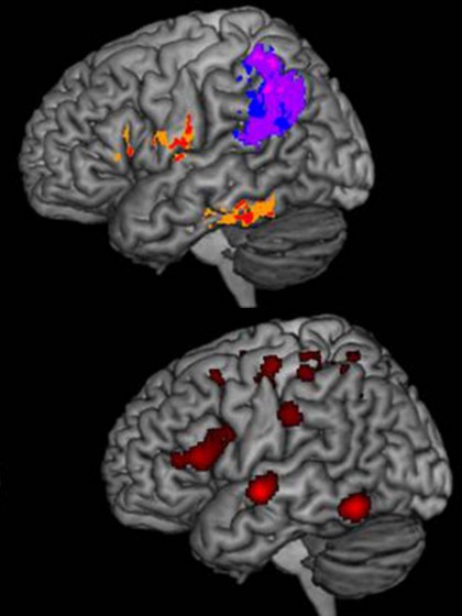 Top: A composite image showing the brain lesions of people with spelling difficulty after strokes. Bottom: An image of a healthy brain depicting the regions typically active during spelling