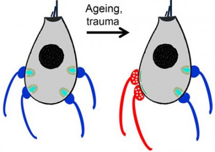 Diagram of age-related hearing loss
