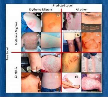 Images of rashes, including the erythema migrans rash associated with Lyme disease