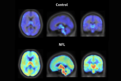 A composite image shows three scans of a control-subject's brain on top. The brain is mostly dark blue with a few traces of light blue. Below is an NFL player's brain, which is mostly like blue/green with areas of red and orange