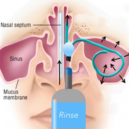 A diagram of the inside of the nose featuring the Salient ENT device