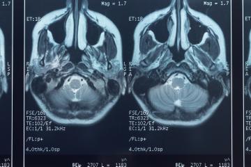 MRI image of a brain's gray matter