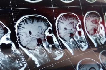 MRI images of brains
