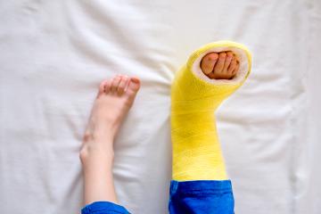 A kid's lower legs lay on a white sheet. The right leg is in a yellow cast.