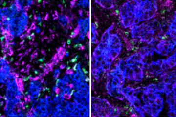 An image of cells that are colored by type: purple and blue cells are metastasis-initiating cancer cells, while green cells are macrophages. The blue and purple are much more prevalent than the green. 