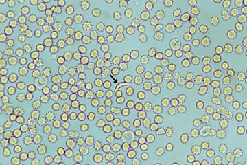 Photomicrograph of sickle cell anemia