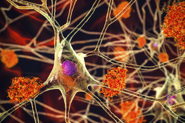 Nerve cells affected by Alzheimer's disease