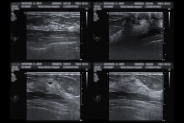 Ultrasound of breast after mammography for diagnosis Breast cancer in women isolated on black background