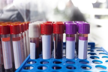 Test tubes containing blood stand in a test tube rack ready for testing