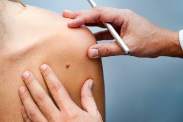 Doctor examines a mole on a woman’s shoulder