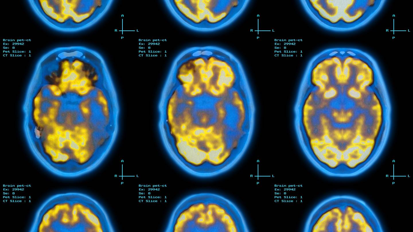 Brain PET scan Brain PET scan