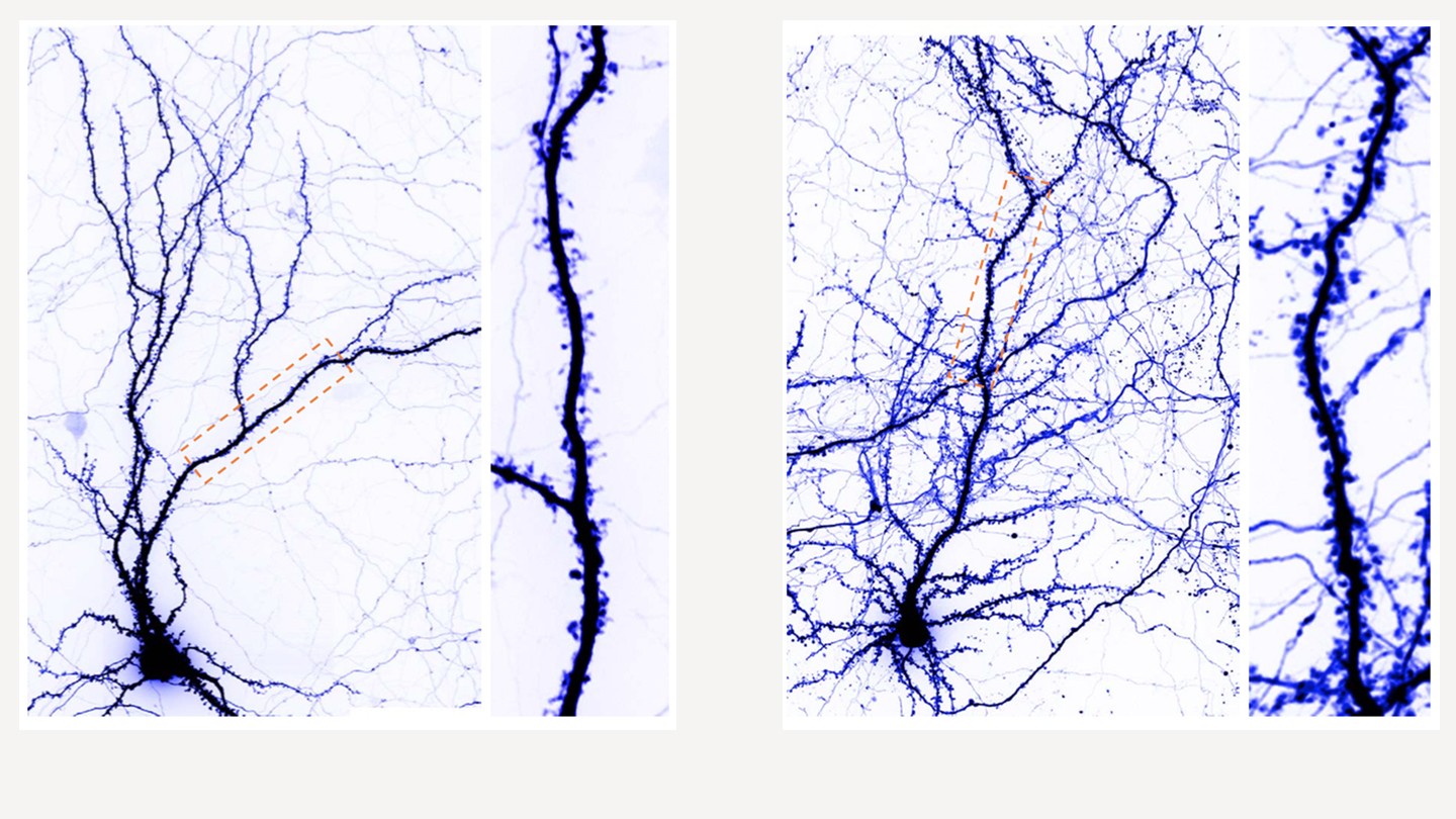 Left images show a normal neuron, and the right image shows an enlarged neuron