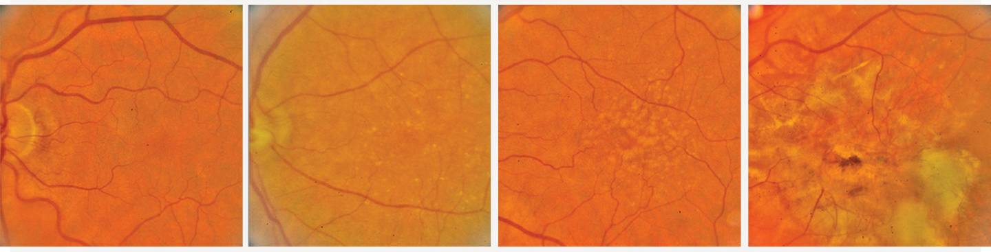 The stages of age-related macular degeneration
