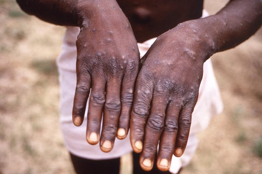 A young man holds out his hands, palm-down, to show large lesions on his skin