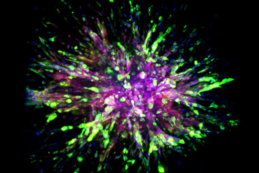 A microscopic view of a triple-negative breast cancer organoid invading collagen tissue appears like an exploding firework, with a purple center surrounded by green lines and dots