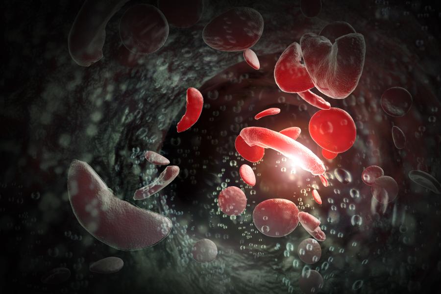 A depiction of sickle cells going through a vein