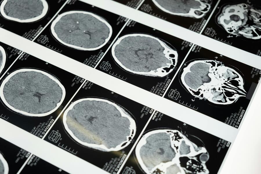 Closeup of MRI images of the brain