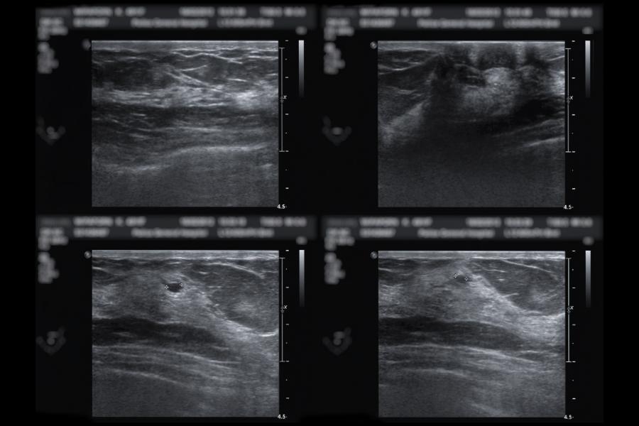 Ultrasound of breast after mammography for diagnosis Breast cancer in women isolated on black background