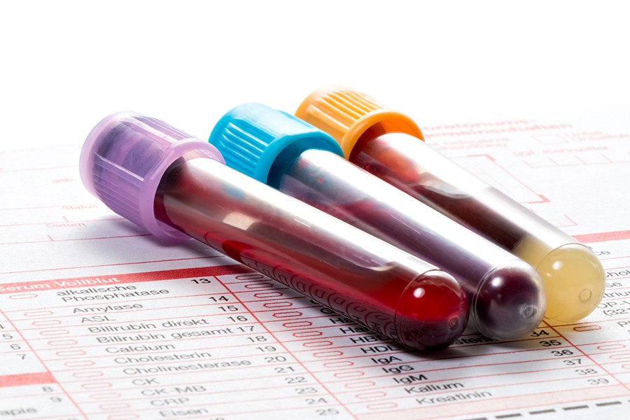 Three vials of blood are topped with different colored caps