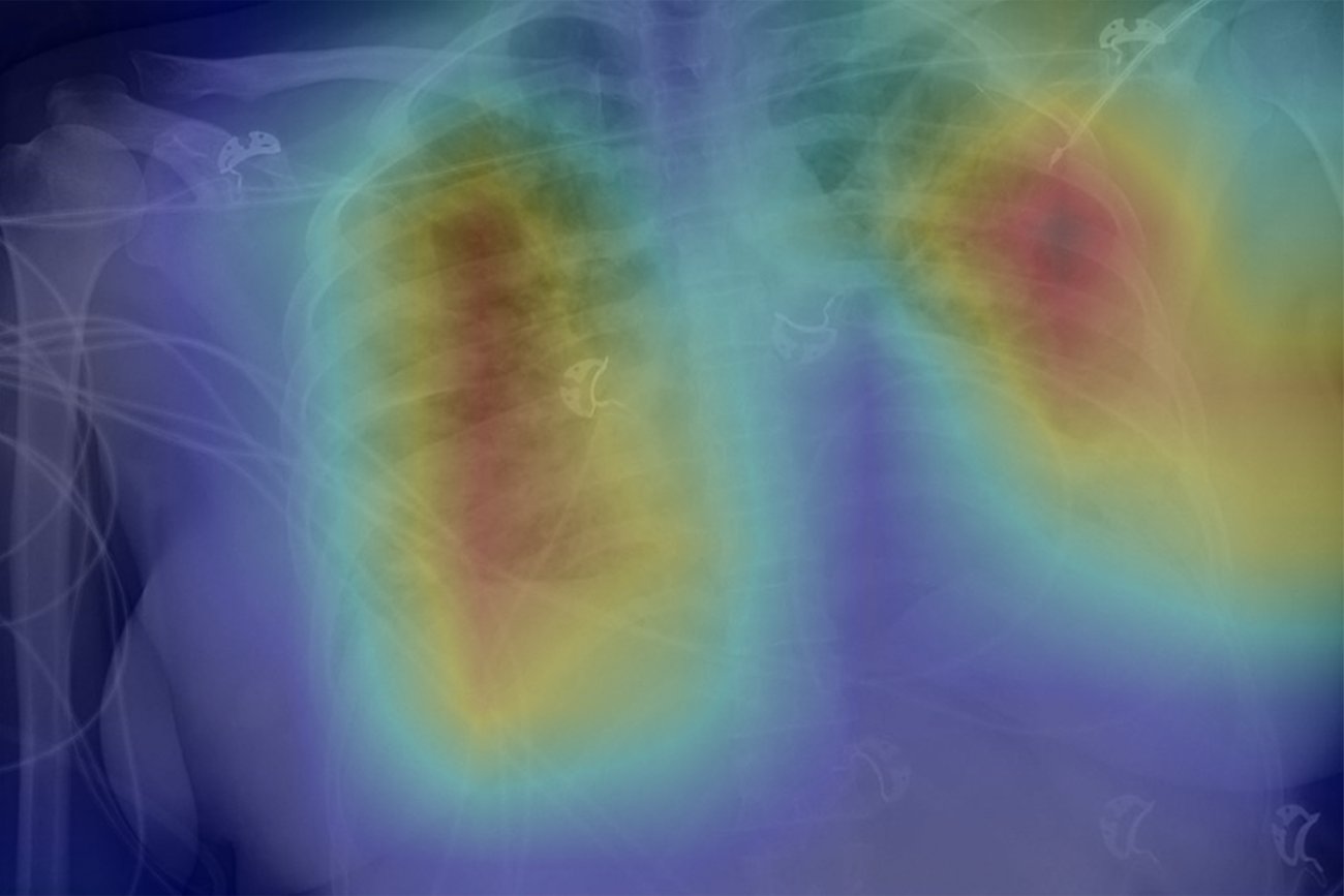 Radiologists use deep learning to find signs of COVID-19 in chest X ...