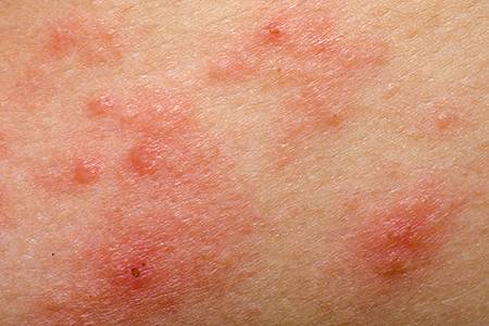 Johns Hopkins experts gain insight into underlying cause of eczema