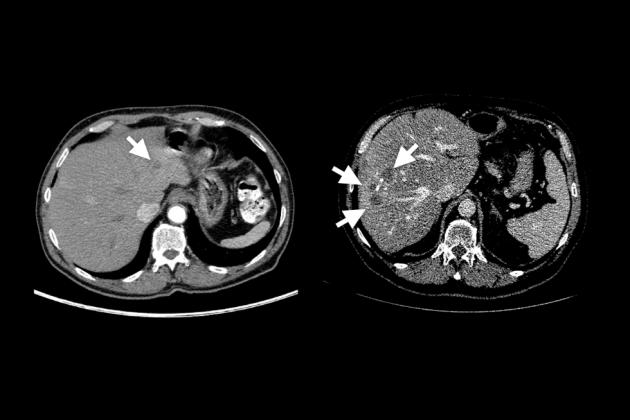 Scans of a real abdominal tumor on the left, vs. synthetic tumors on the right