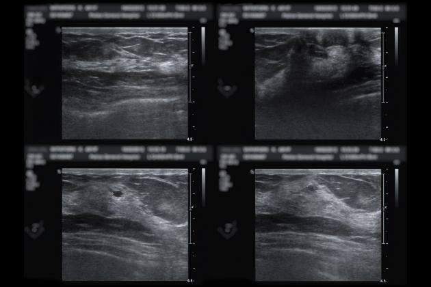 Ultrasound of breast after mammography for diagnosis Breast cancer in women isolated on black background